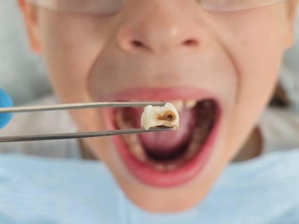Best Urgent Dental Care for Toothache in Clay City, IN